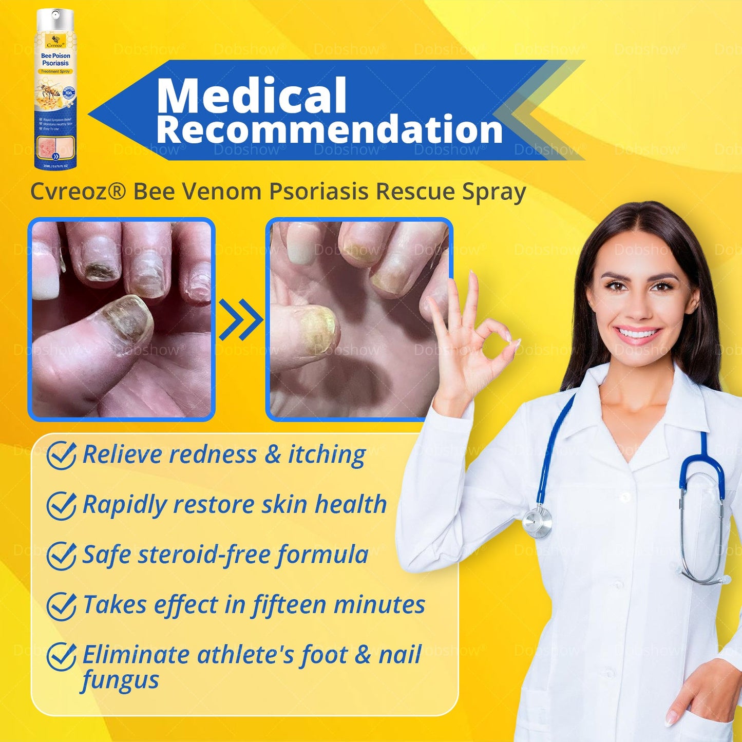 Cvreoz® Bee Venom Psoriasis Treatment Spray