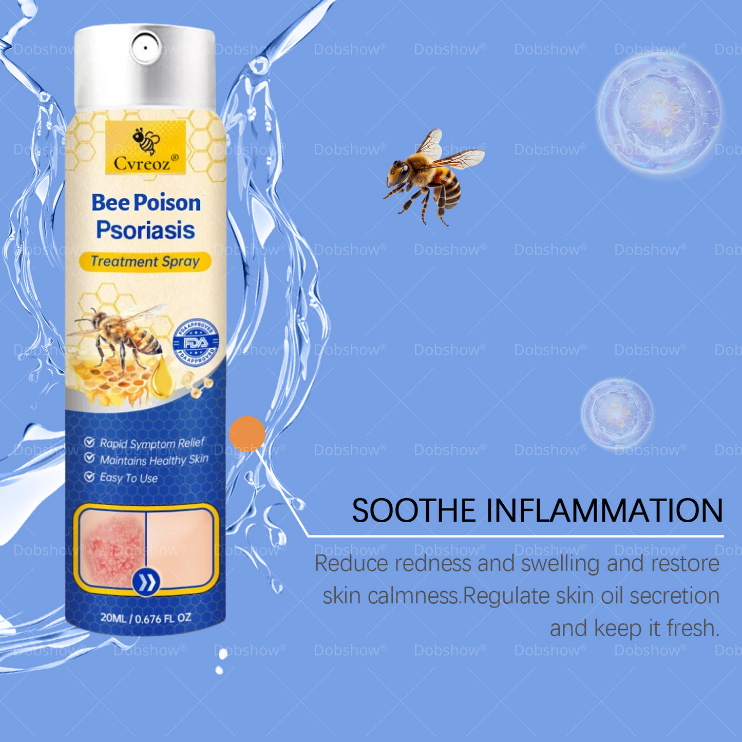 Cvreoz® Bee Venom Psoriasis Treatment Spray