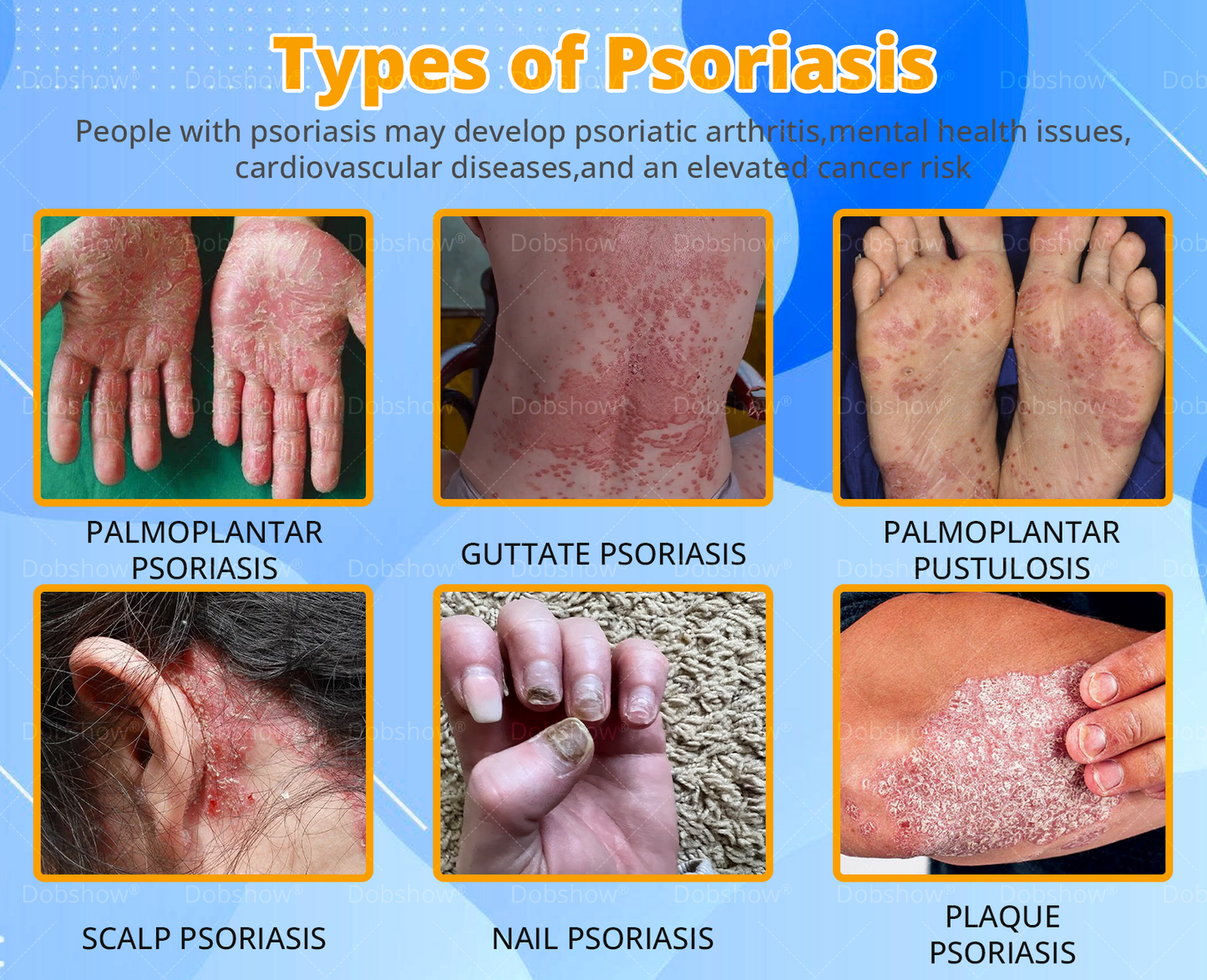Cvreoz® Bee Venom Psoriasis Treatment Spray