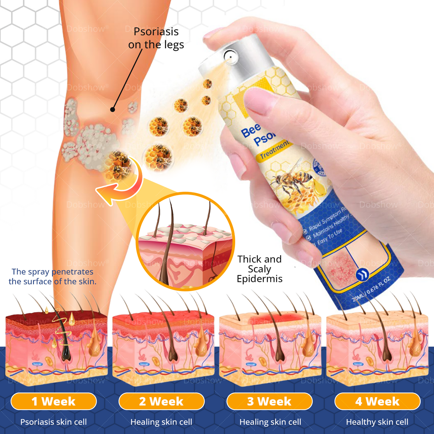 Cvreoz® Bee Venom Psoriasis Treatment Spray