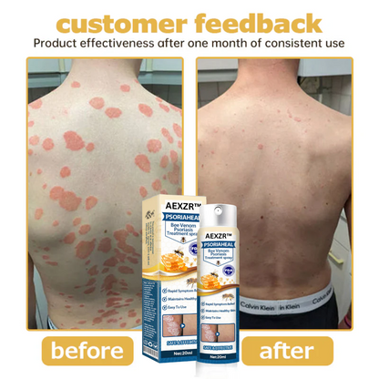 AEXZR™ PsoriaHeal Bee Venom Psoriasis Treatment Spray 🔥 Last Day Sale Off 80%🔥