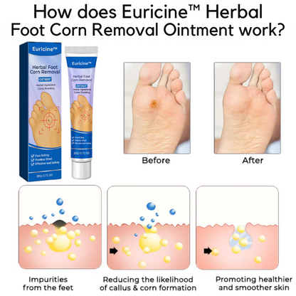 Euricine™ Herbal Foot Corn Removal Ointment