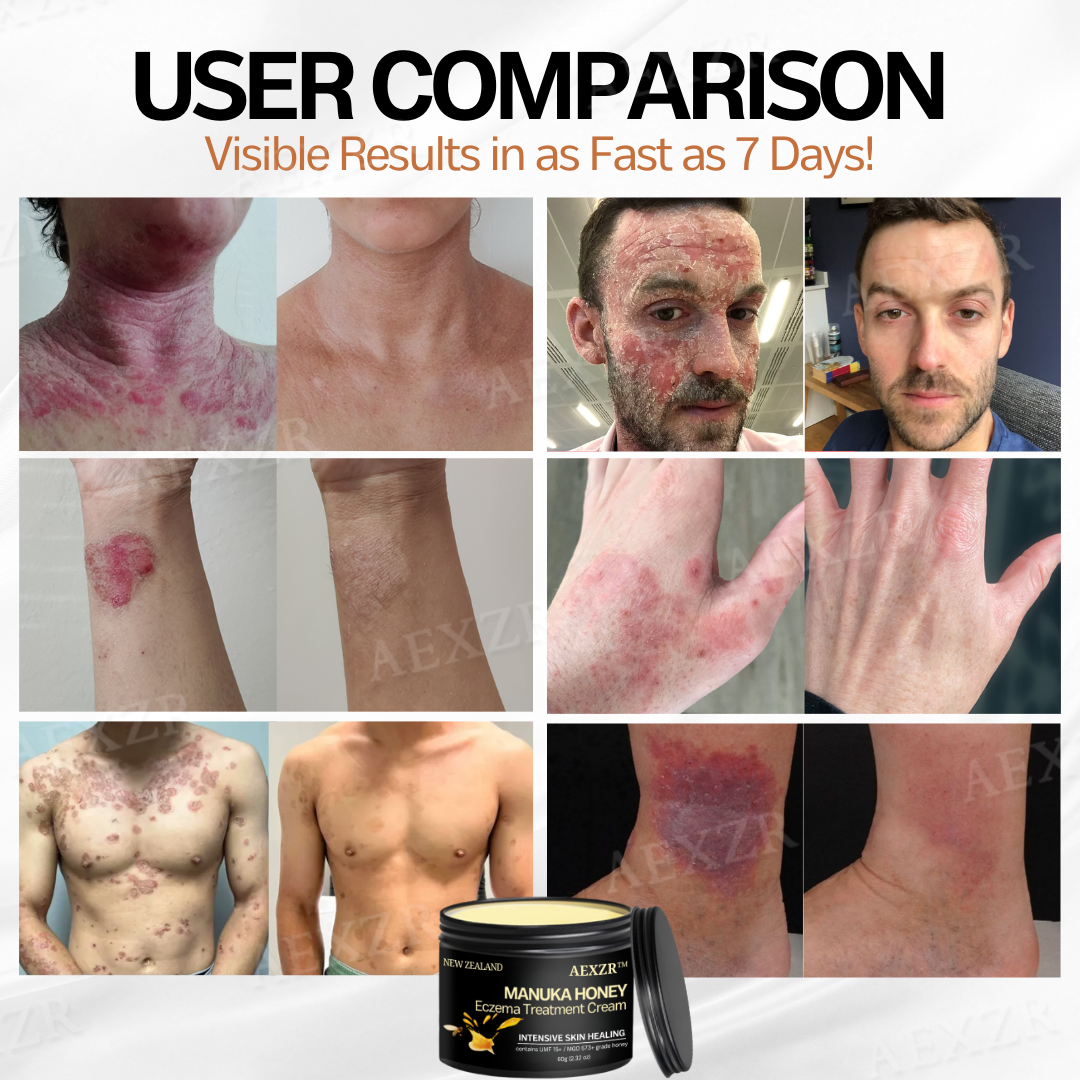 AEXZR™ New Zealand Manuka Honey Eczema Treatment Cream