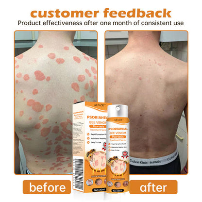 AEXZR™ PsoriaHeal Bee Venom Psoriasis Treatment Spray 💥Get Instant Relief💥