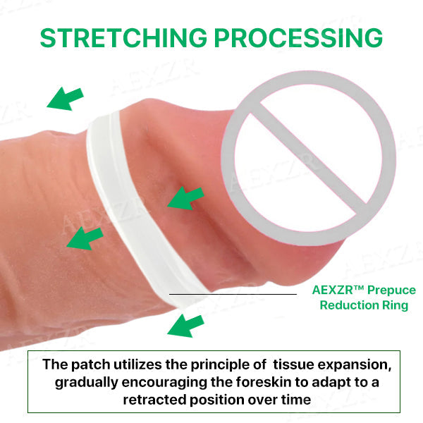 AEXZR™ Prepuce Reduction Ring