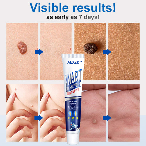 AEXZR™ Wart Removal Ointment